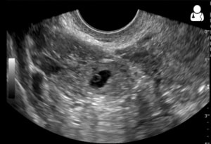 Ectopic Pregnancy image